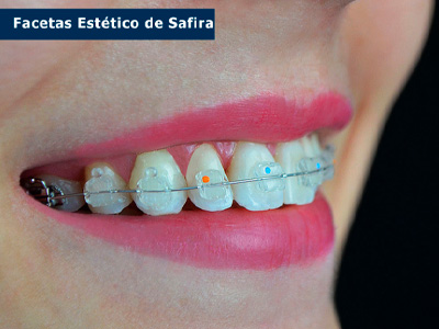 Aparelhos Dentários Ijuí RS