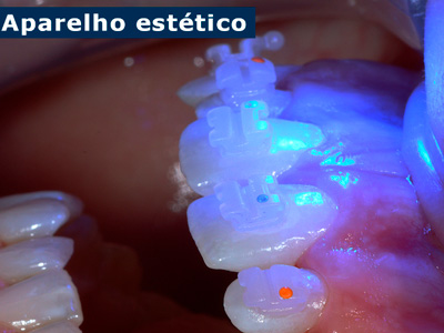 Aparelhos Dentários Ijuí RS