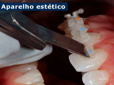 Aparelhos Dentários Ijuí RS