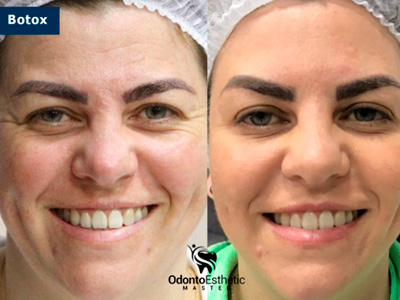 Harmonização Orofacial Ijuí RS