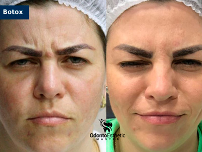 Harmonização Orofacial Ijuí RS