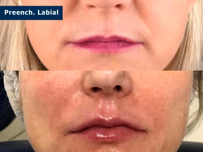 Harmonização Orofacial Ijuí RS