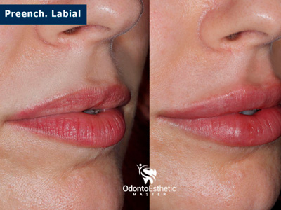 Harmonização Orofacial Ijuí RS