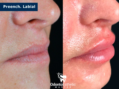 Harmonização Orofacial Ijuí RS